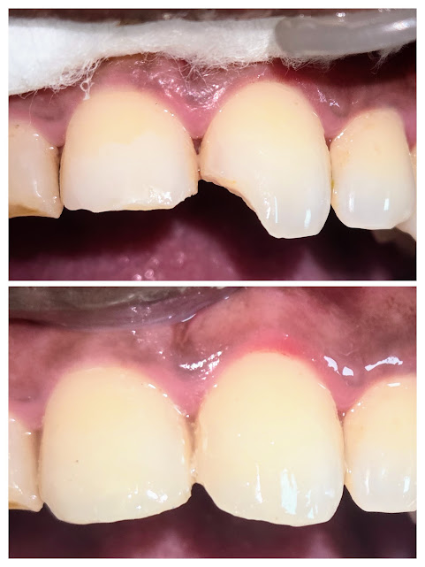 Before and after clinical comparison collage of anterior aesthetic composite restorations (tooth-colored fillings) at Elegance Dental Clinic, Rajapalayam