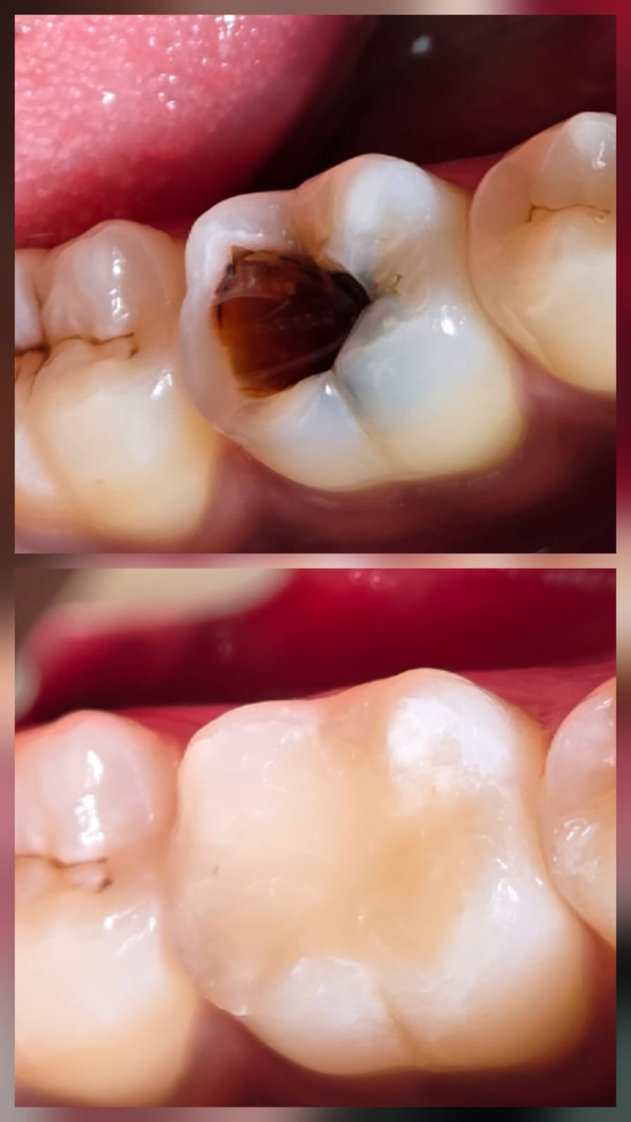 Before and after clinical comparison collage of posterior composite restorations (tooth-colored fillings) at Elegance Dental Clinic, Rajapalayam