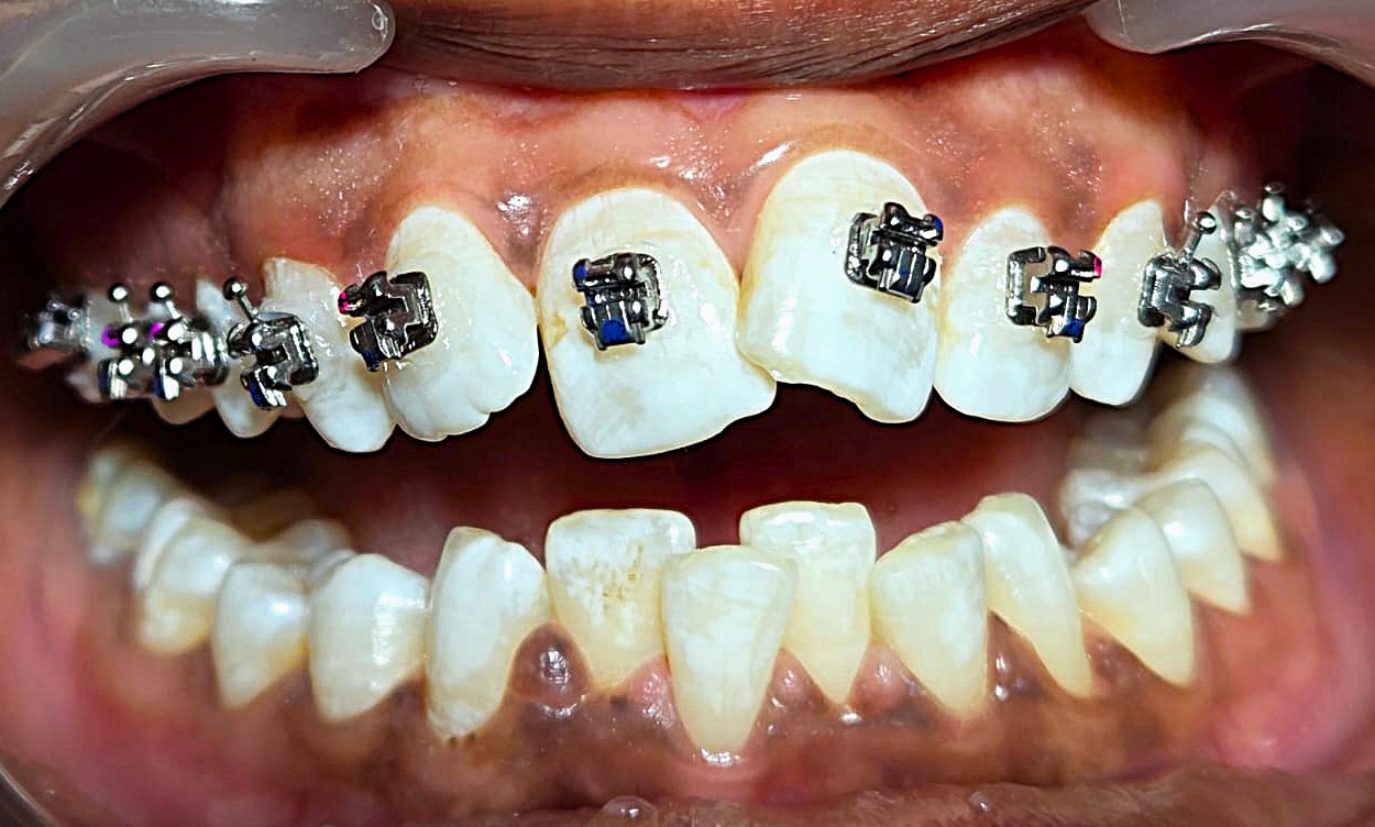 Close-up view of orthodontic bonding featuring advanced self-ligating brackets on teeth during braces treatment at Elegance Dental Clinic.