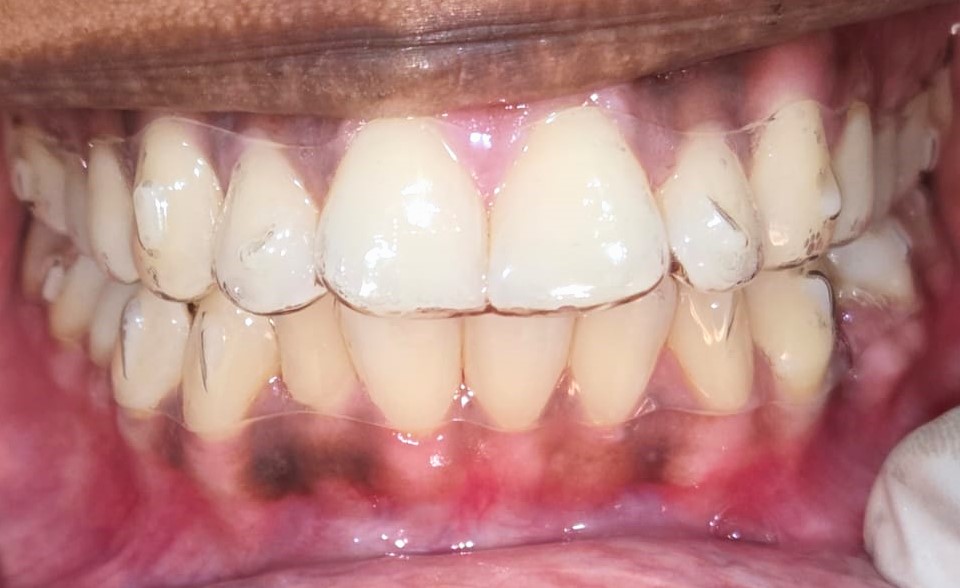 Clear aligner tray seated over teeth with precise, tooth-colored composite attachments for specialized orthodontic treatment at Elegance Dental Clinic, Rajapalayam.